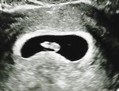 эмбрион человека на узи, 7 неделя беременности