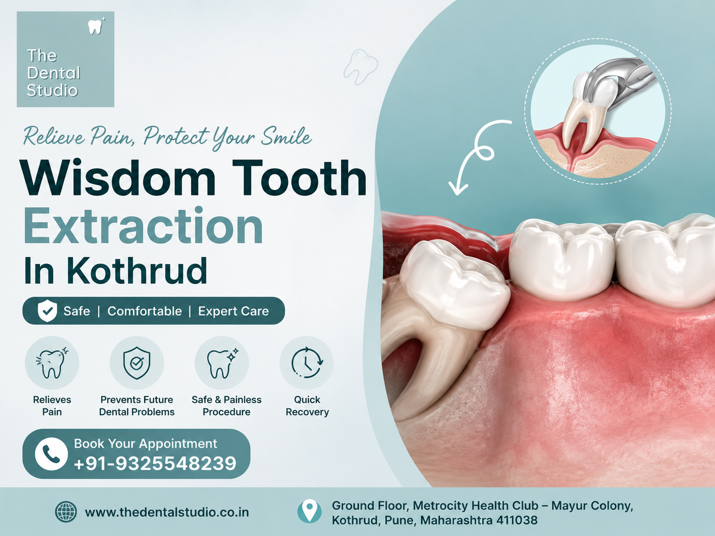 Wisdom Tooth Extraction in Kothrud