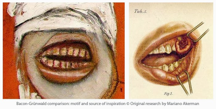 Справа фрагмент картины Бэкона, слева иллюстрация из&nbsp;«Атласа заболеваний рта, горла и&nbsp;носа».