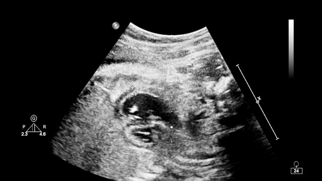 HIFU Market to Reach $242.58 Million by 2033 Growth Surge