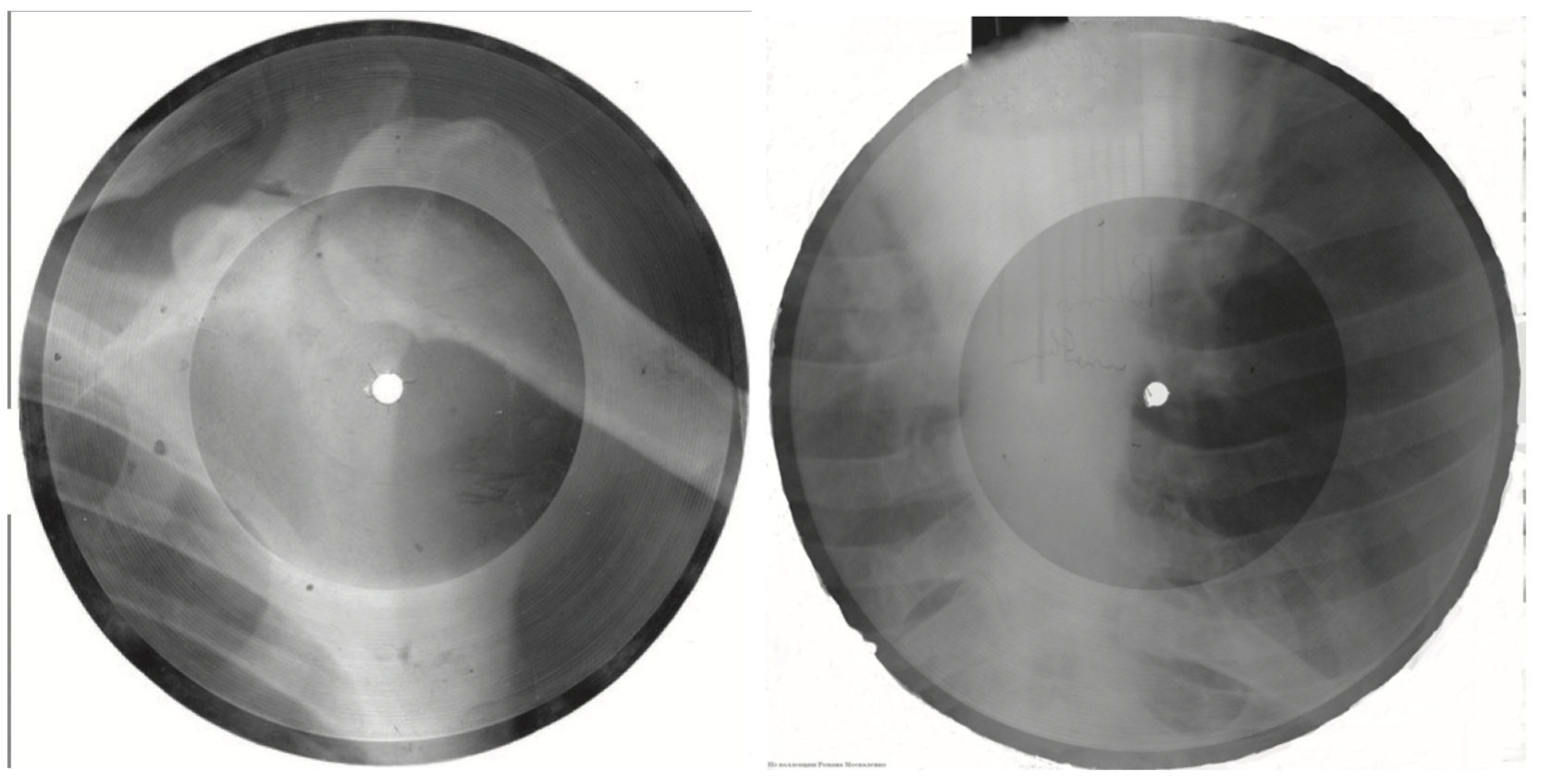 «Рок на&nbsp;костях». Пластинки на&nbsp;рентгеновских снимках. Фото автора