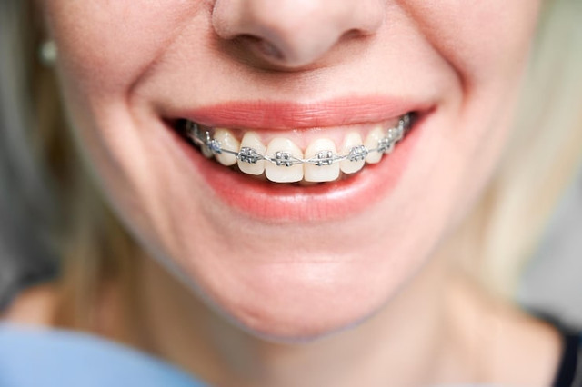 Braces in Camarillo: A Path to a Healthier Smile