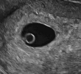 эмбрион человека на узи, 5 неделя беременности