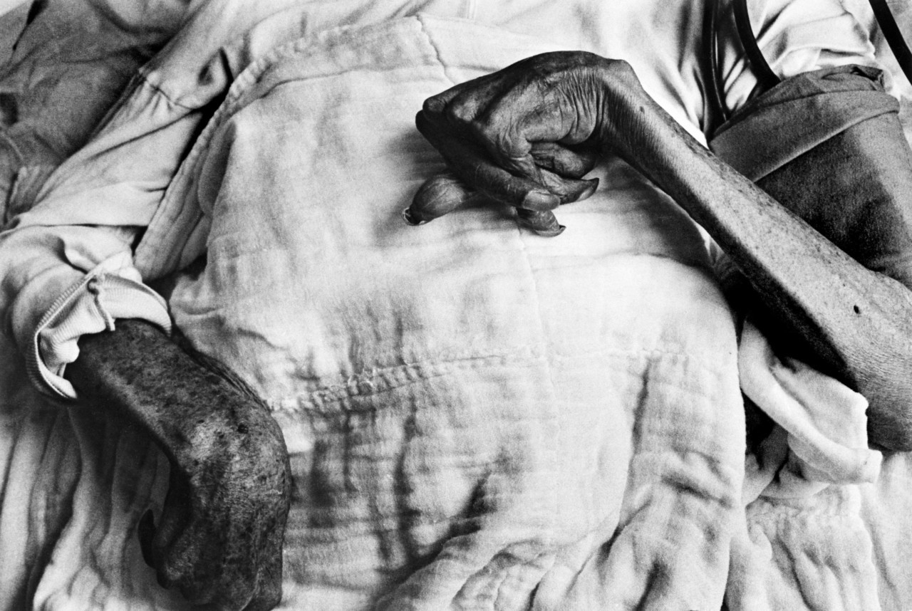 Ивазо Фунаба, жертва болезни Минамата, 1971&nbsp;г. © W. Eugene Smith | Magnum Photos